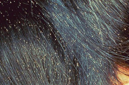 Foto - Kepek oluşumunun nedenleri ve kurtulmak için ipuçları