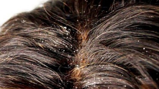 Foto - Kepek oluşumunun nedenleri ve kurtulmak için ipuçları