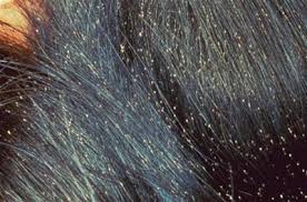 Foto - Kepek oluşumunun nedenleri ve kurtulmak için ipuçları