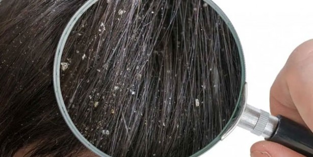 Foto - Kepek oluşumunun nedenleri ve kurtulmak için ipuçları