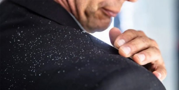 Foto - Kepek oluşumunun nedenleri ve kurtulmak için ipuçları