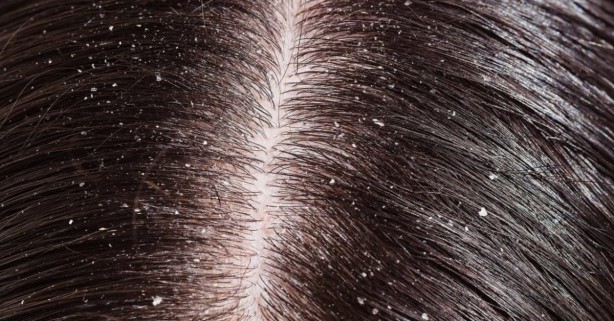 Foto - Kepek oluşumunun nedenleri ve kurtulmak için ipuçları