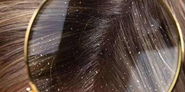 Foto - Kepek oluşumunun nedenleri ve kurtulmak için ipuçları