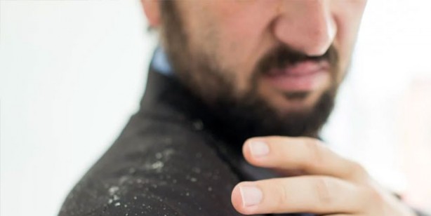 Foto - Kepek oluşumunun nedenleri ve kurtulmak için ipuçları