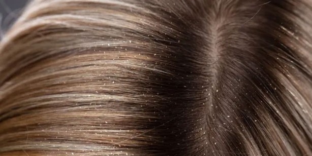 Foto - Kepek oluşumunun nedenleri ve kurtulmak için ipuçları