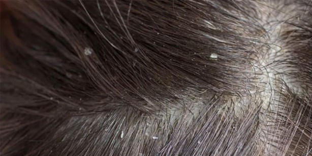 Foto - Kepek oluşumunun nedenleri ve kurtulmak için ipuçları