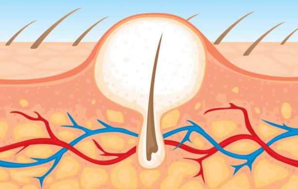 Foto - Kıl dönmesi tedavisi geç kalırsa ne olur?