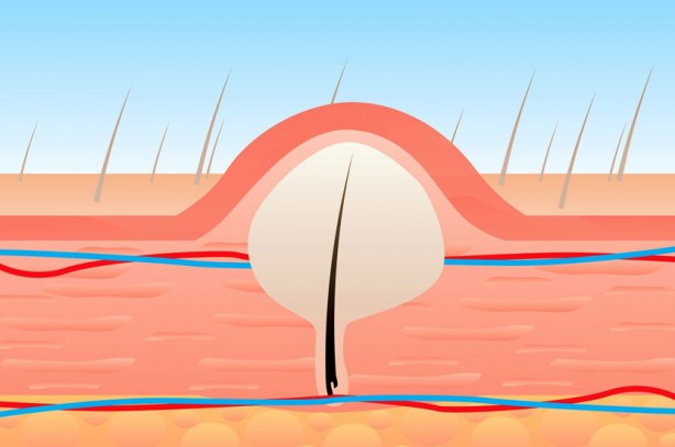 Foto - Kıl dönmesi tedavisi geç kalırsa ne olur?