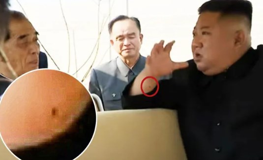 Foto - “Sağ bileğindeki yara izi kalple ilgili bir operasyon geçirdiğini gösteriyor olabilir. Bu yara izinin olduğu bölge damarlara stent takmak için oluşturulmuş olabilir.”