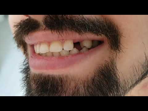 Foto - Kimse farkında değil! Eksik dişler sağlığımızı nasıl etkiler