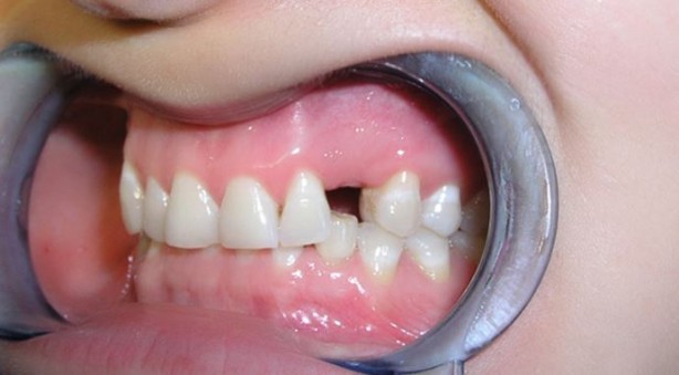 Foto - Kimse farkında değil! Eksik dişler sağlığımızı nasıl etkiler