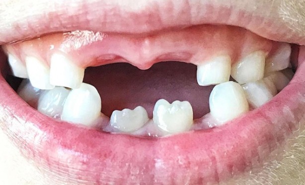 Foto - Kimse farkında değil! Eksik dişler sağlığımızı nasıl etkiler
