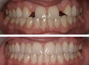 Kimse farkında değil! Eksik dişler sağlığımızı nasıl etkiler