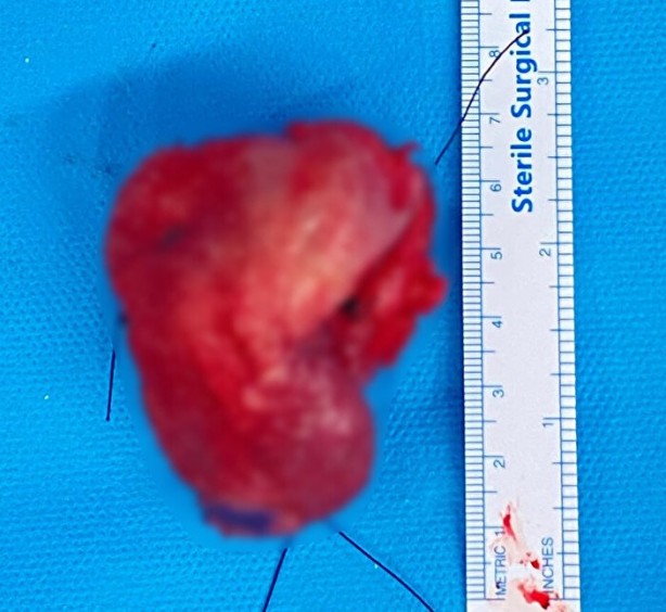 Foto - Kırık dişi olanlar dikkat! Ölümcül dil kanseri oldu