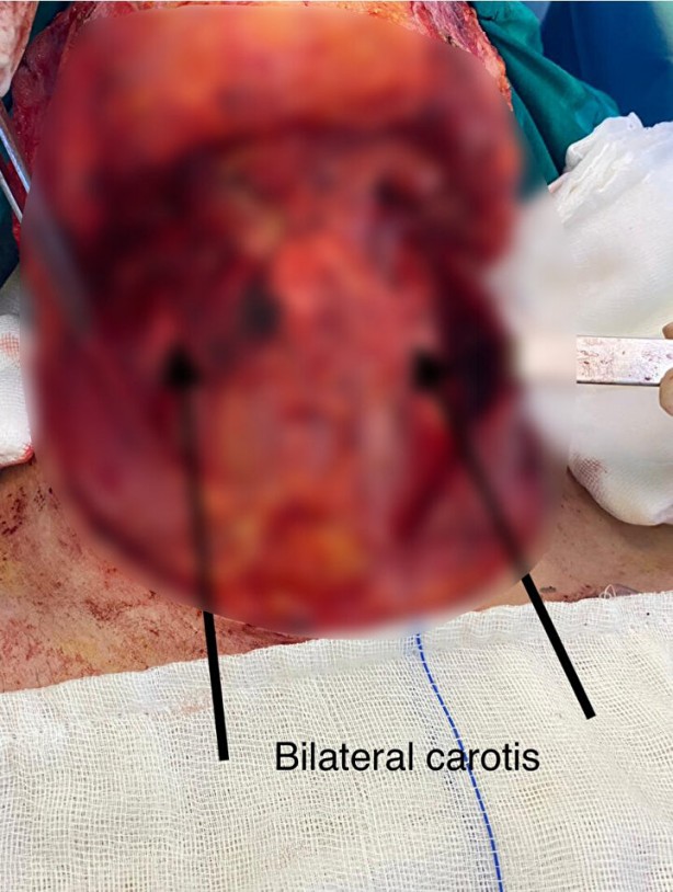Foto - Kırık dişi olanlar dikkat! Ölümcül dil kanseri oldu