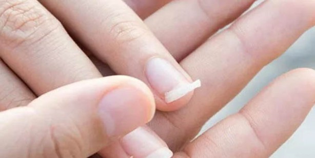 Kırılan tırnak nasıl onarılır? Kırılgan tırnakları güçlendiren doğal besinler