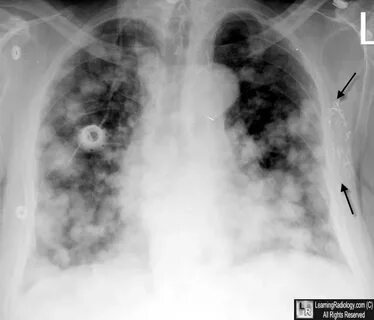 Foto - Kirli hava akciğer kanseri sebebi