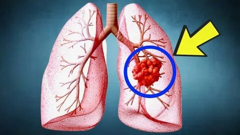 Foto - Kirli hava akciğer kanseri sebebi