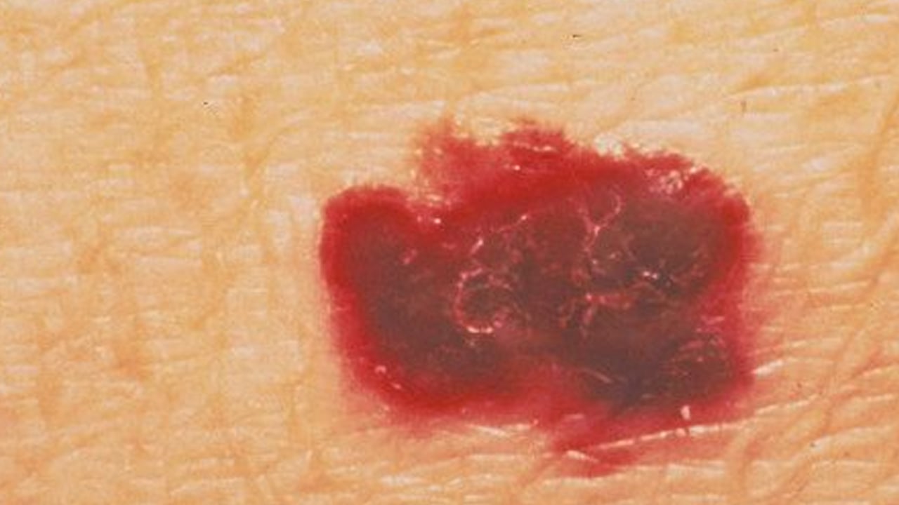 Kırmızı ben neden olur? Kırmızı et beni tehlikeli midir? İşte iki profesör tek tek anlattı, verilerini açıkladı 