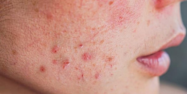 Foto - Kısa sürede cilt lekelerini geçiriyor! Bu etkisini kimse bilmiyor