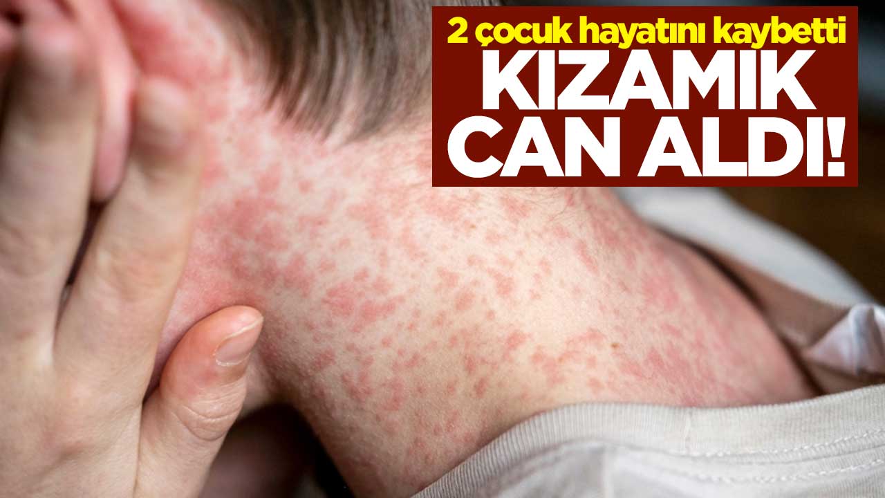 Kızamık can aldı! 2 çocuk hayatını kaybetti