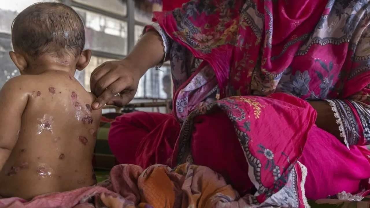 Foto - Kızamıktan korkunç haber! Ölen çocuk sayısı 1201'e yükseldi