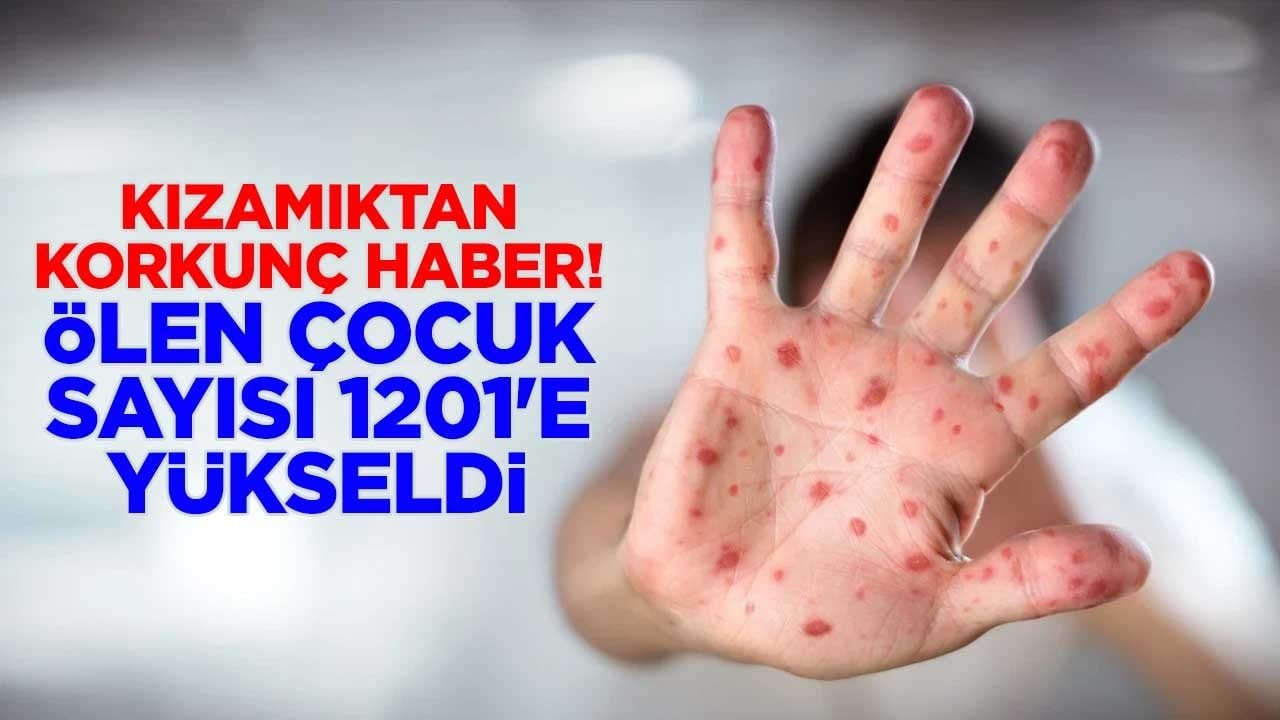 Kızamıktan korkunç haber! Ölen çocuk sayısı 1201'e yükseldi