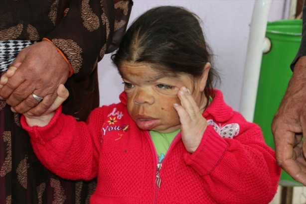 Foto - Kızını 36 senedir sırtında taşıyor