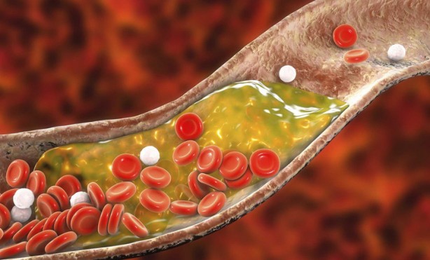 Foto - Kolesterolü düşürmek için en iyi 6 yol