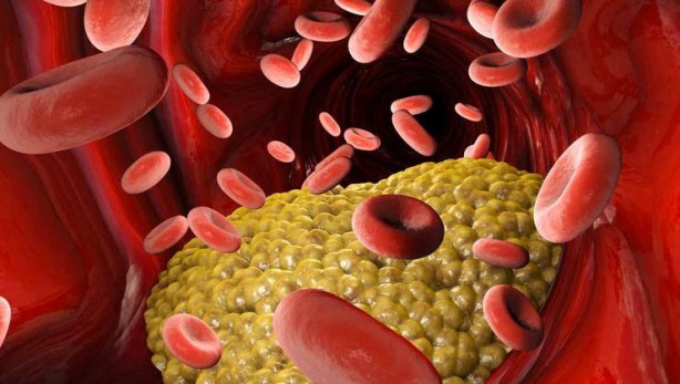 Foto - Kolesterolü düşürmek için en iyi 6 yol