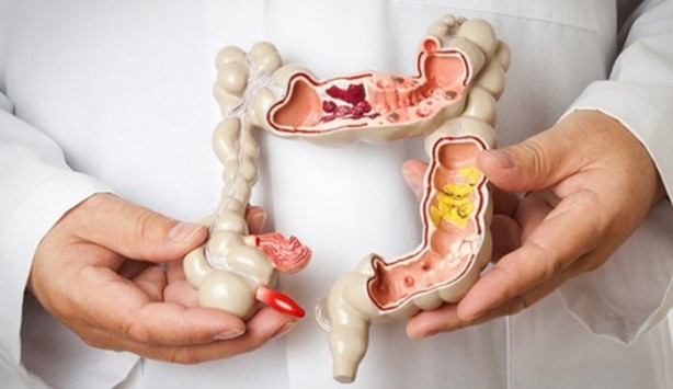 Foto - Kolon kanserinden korunmak için böyle beslenin