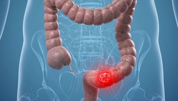 Foto - Kolon kanserinden korunmak için böyle beslenin