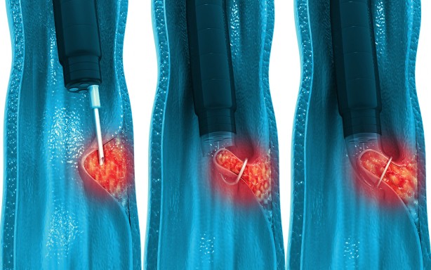 Foto - Kolon kanserinden korunmak için böyle beslenin