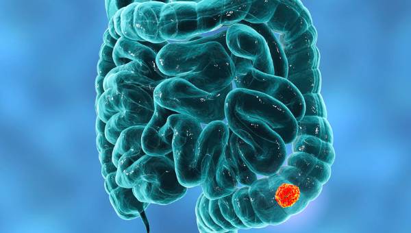 Foto - Kolon kanserinden korunmak için böyle beslenin