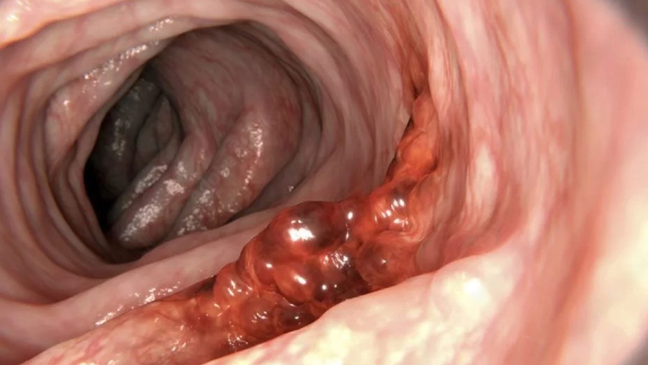 Foto - Kolon kanserine neden oluyor: 50 yaş üstü erkeklerde belirti vermiyor! Meğer yanlış biliyormuşuz