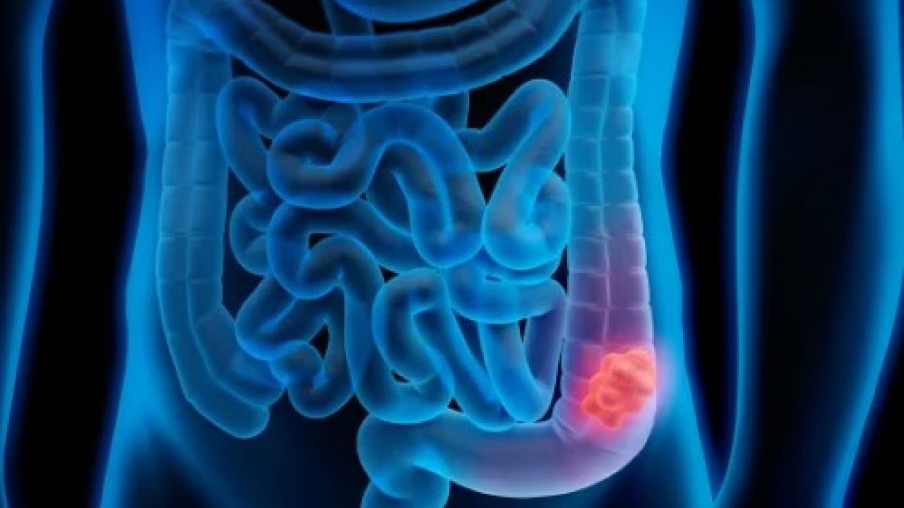 Foto - Kolon kanserine savaş açıyor: Günde 5 tane yetiyor!