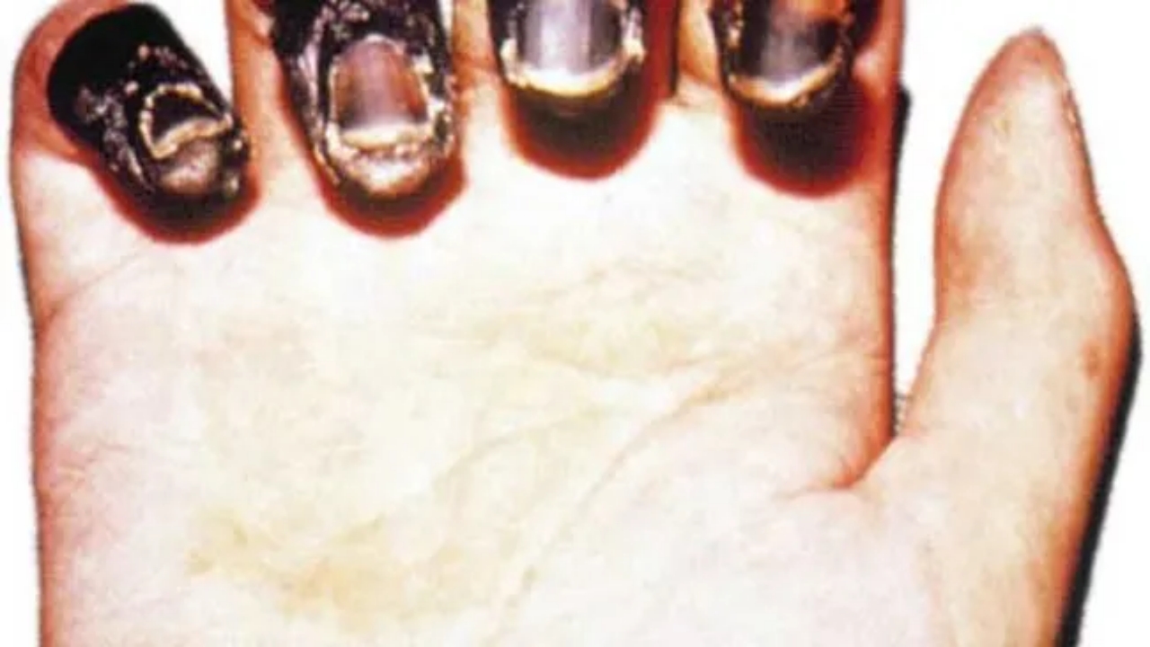 Foto - Korona falan değil! İnsanlık tarihinin en ölümcül hastalığı yeniden hortladı