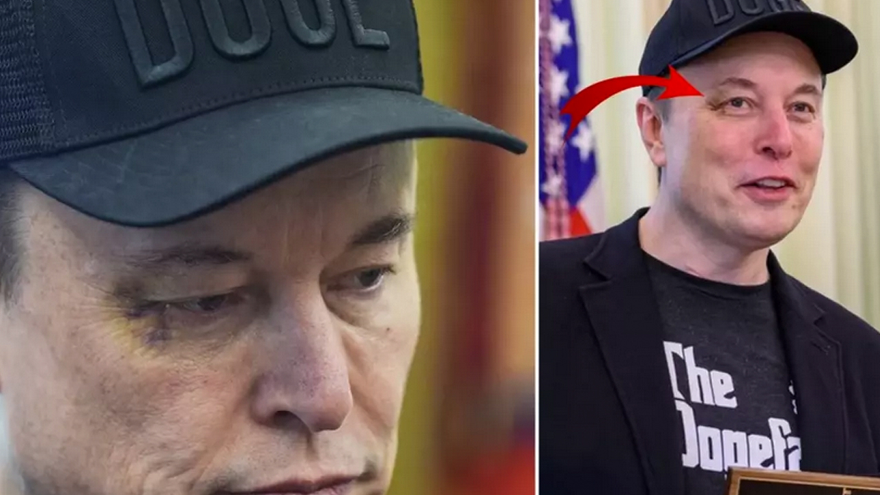 Kritik detay ortaya çıktı! Yeni sır: Elon Musk'ın gözündeki morlukla ilgili bomba iddia