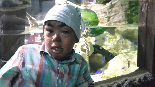 Foto - Küçük çocuk üç yıldır gözlerini kapatamıyor 