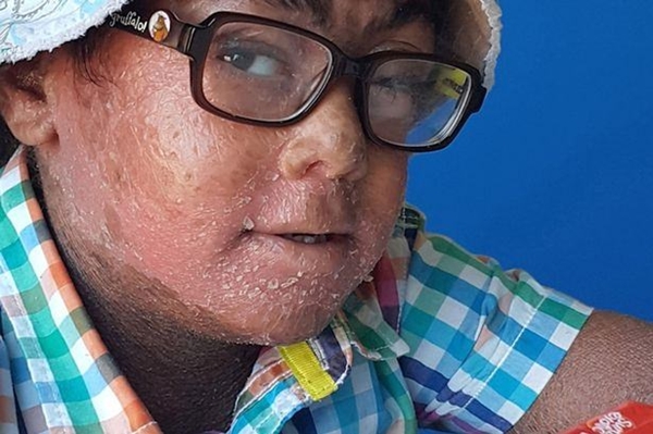 Küçük çocuk üç yıldır gözlerini kapatamıyor 