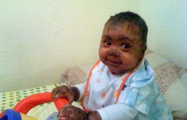 Foto - Küçük çocuk üç yıldır gözlerini kapatamıyor 