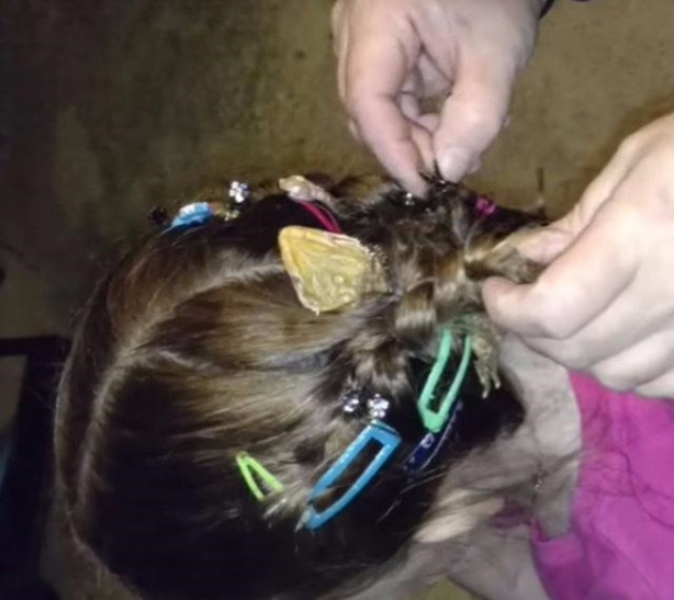 Foto - Küçük kızın kafasından çıkan şey aileyi şoka soktu!