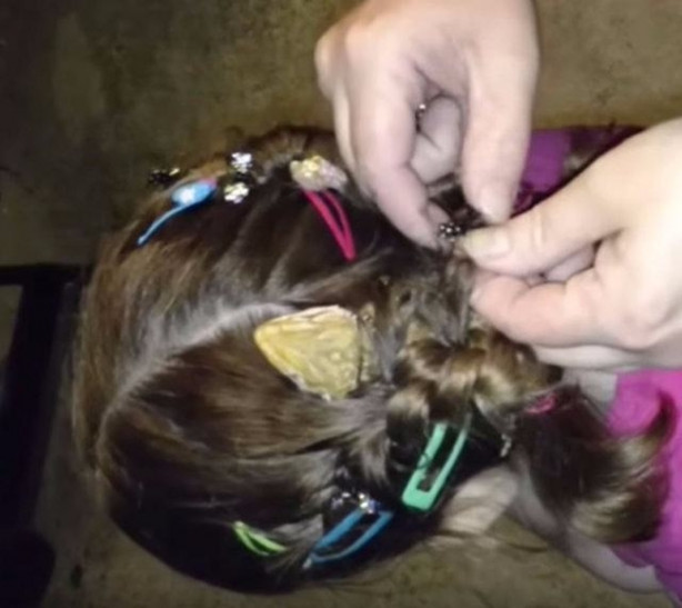 Foto - Küçük kızın kafasından çıkan şey aileyi şoka soktu!