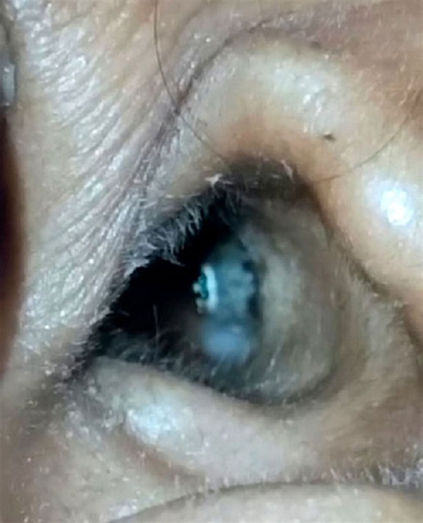 Foto - Kulağından çıkanı görünce şok oldu!