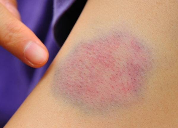 Foto - Kulağınıza mentollü krem sürerseniz...