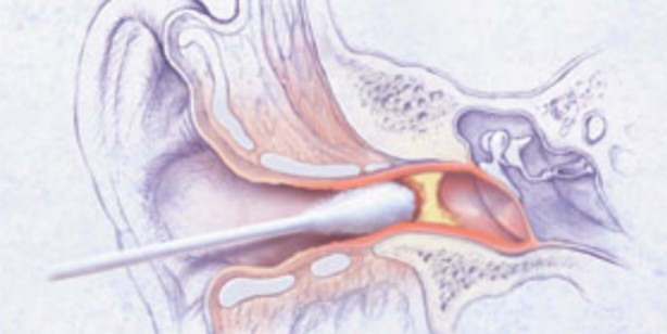 Foto - Kulak kiri sağlığımızın durumunu söylüyor: Kulakta ağrı ve tıkanma hissi varsa dikkat! İlaçlar onun kadar bile olamadı