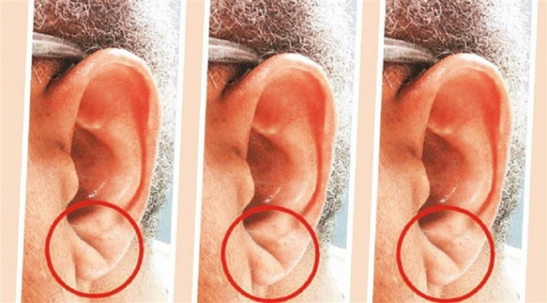 Foto - Kulak memesindeki çizgiye dikkat!