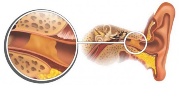 Foto - Kulak tıkanıklığını giderecek 3 pratik yöntem