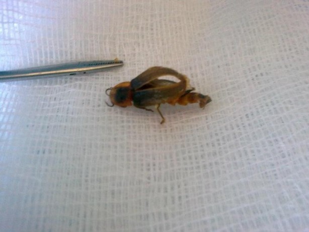 Foto - Kulaktan çıkanlar görenleri şok etti!