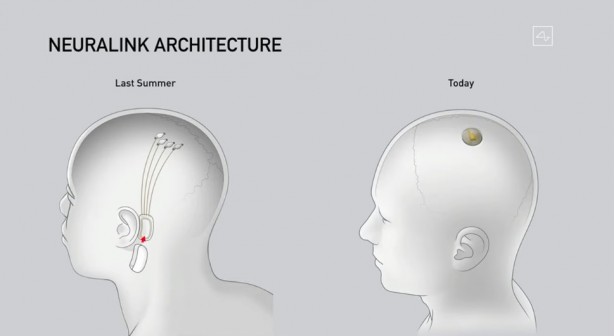 Foto - Küreselciler insanlığı robotlaştırmak için iş başında! Ve Elon Musk çipi tanıttı